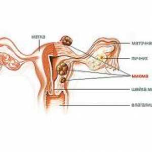 Матката fibroids мали димензии