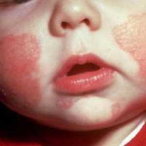 Атопичен дерматитис кај деца