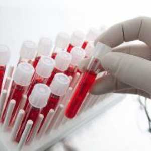 Вкупниот билирубин - Стапката на крв кај жените