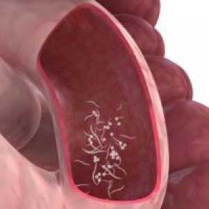 Pinworms кај децата - симптоми