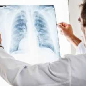 Пневмоторакс белите дробови