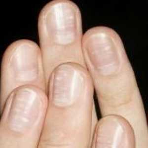 Зошто ноктите стануваат брановидна?