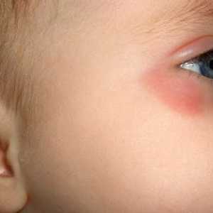 Зошто детето може да биде црвена под очите