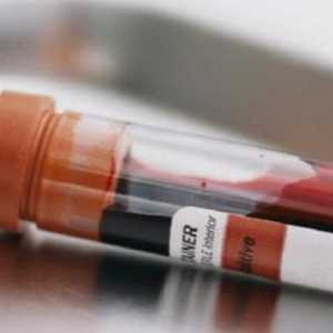 Зголемување на инсулин во крвта - Причини