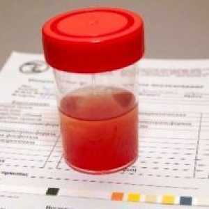 Зголемување на црвени крвни клетки во урината