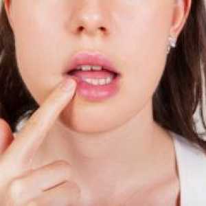 Рак на усните - симптоми, раните знаци