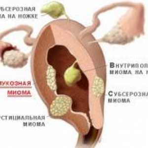 Субмукозни матката fibroids - третман