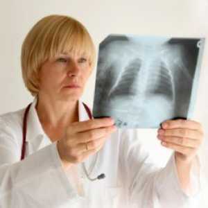 Туберкулоза - Симптомите