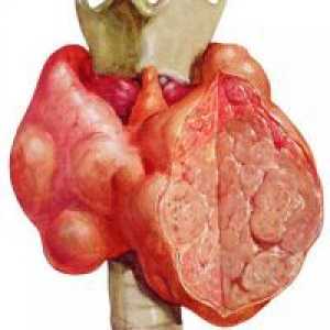 Нодуларен гушавост на тироидната жлезда - Симптоми и лекување