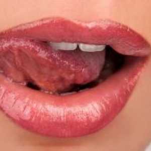 Воспаление на јазикот